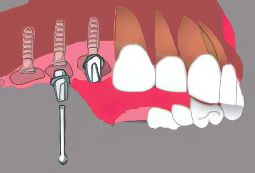 Implants dentaires Nimes Nicolas Henner